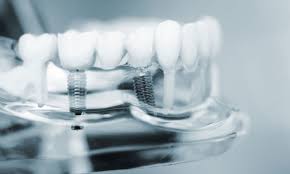 Dental Implants – Ultradent